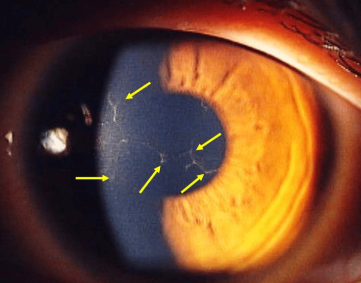 Рис. 1. Изображение левого глаза во время первого визита. В роговице можно увидеть дендриты (стрелки)