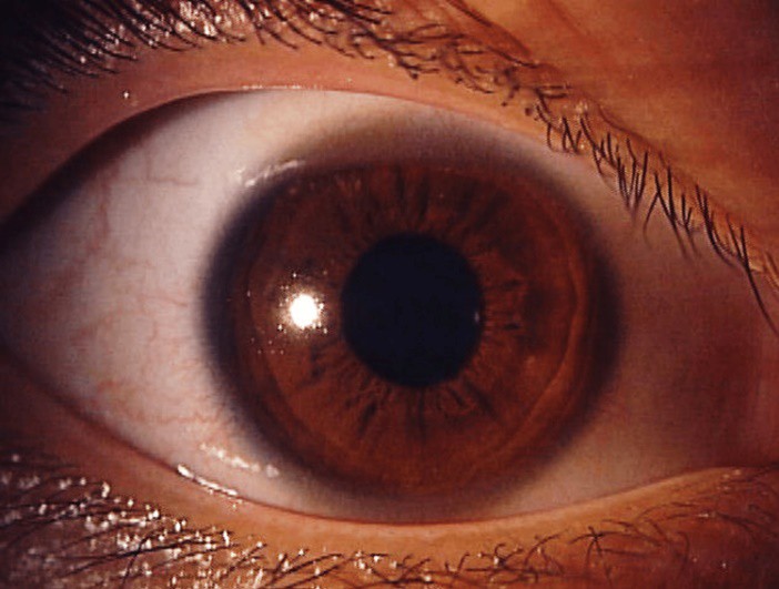 Рис. 4. Глаз после лечения глазной мазью ацикловира. В левом глазу все находки исчезли